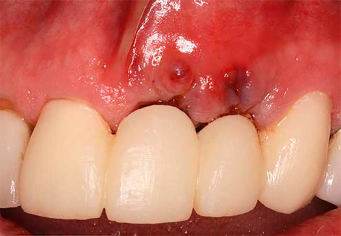 Признаки и симптомы отторжения импланта зуба. Почему они не приживаются