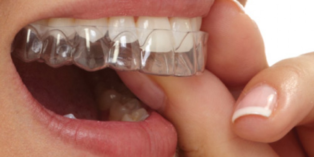 Плюсы и минусы отбеливающих кап для зубов. Факты, которые необходимо знать