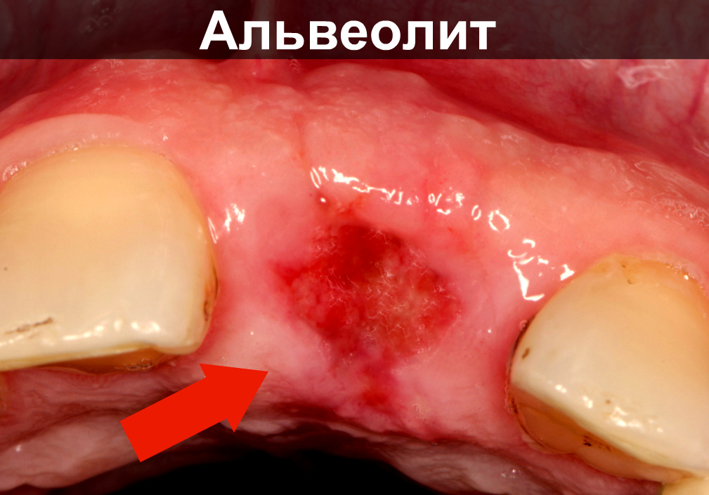 Симптомы и лечение кисты зуба. Чем опасно новообразование в ротовой полости