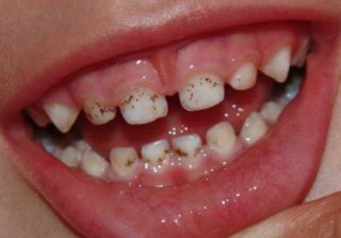 Некрасивая проблема черные зубы у детей