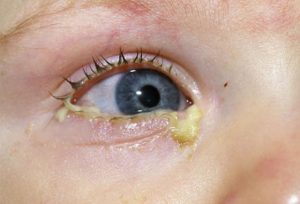 Лечение детского конъюнктивита глаз по Комаровскому