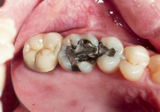 Причины и симптомы кариеса зубов узнаем, как предотвратить болезнь или избавиться от неё