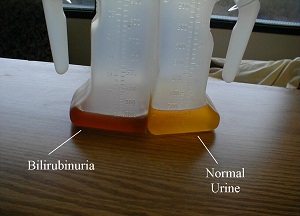 норма и отклонения показателей билирубина в моче