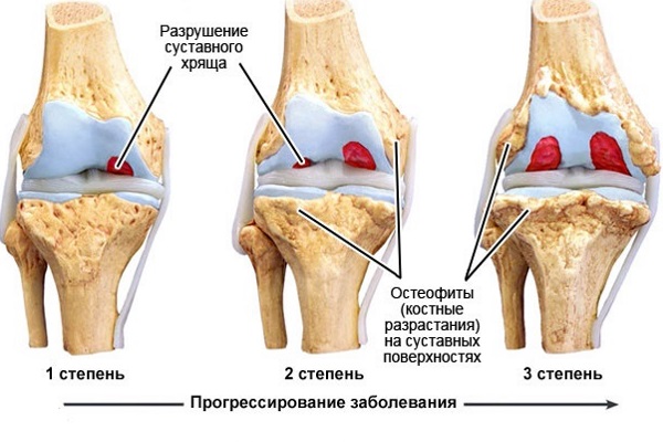 Стадии артроза коленного сустава