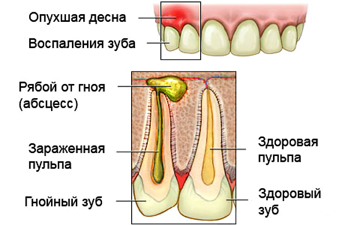 Воспалительный процесс в нерве зуба гнойный пульпит