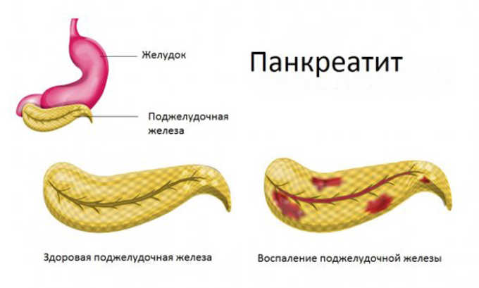 Раздражение стенок железы провоцирует рецидив панкреатита
