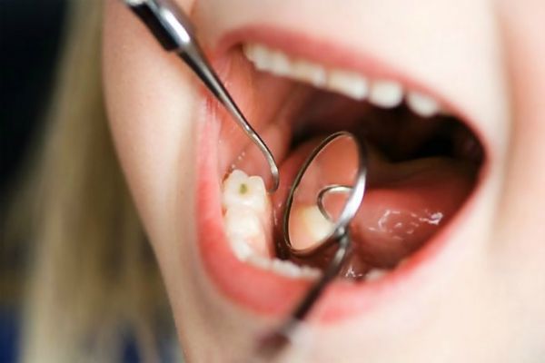 Кариес полочных зубов характеризуется деминерализационным процессом