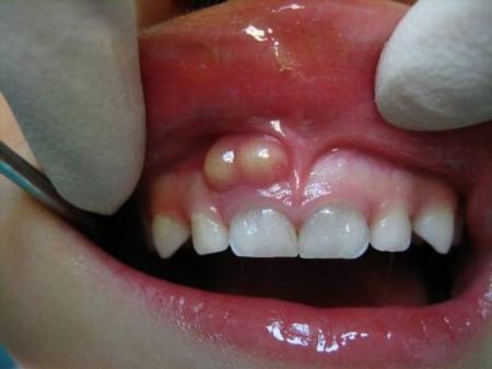 Как лечить свищ у ребенка на десне молочного зуба