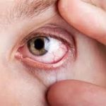 Грибковые заболевания глаз