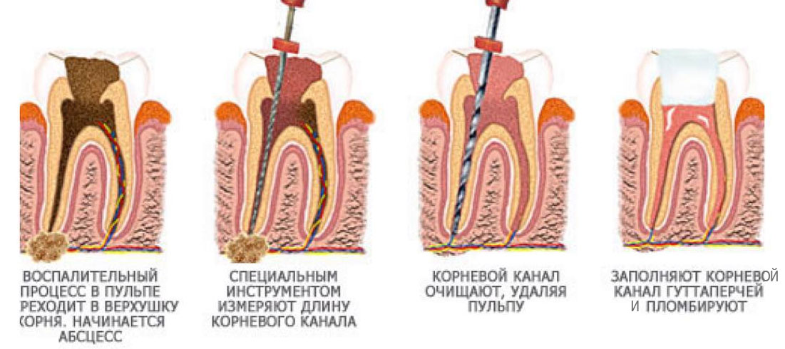1 корневой канал. 4 Канальный пульпит зуба. Витальная экстирпация пульпы. Пульпит 3 канального зуба.