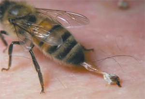 противопоказания к пчелиному яду