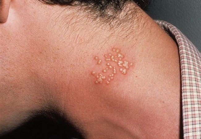 Мази для лечения герпеса на коже