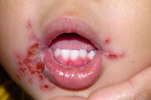 Пузырьковая сыпь герпесный стоматит у детей. Лечение