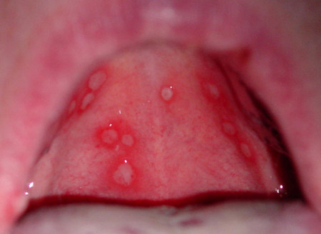 Язвы во рту афтозный стоматит у детей. Лечение и симптомы