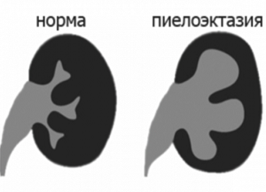 как лечить пиелоэктазию левой почки