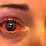 Понижаем глазное давление в домашних условиях