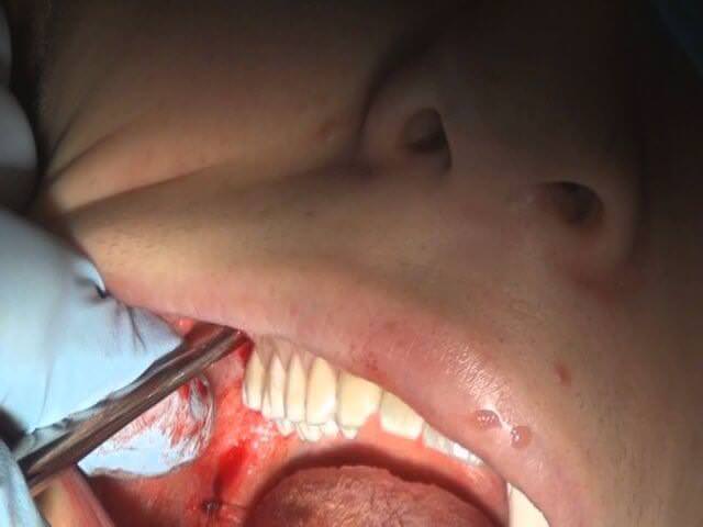 Как происходит удаление зуба мудрости на верхней челюсти. Сложность операции и её возможные последствия