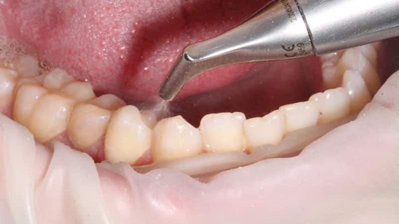 Как делается гигиеническая профессиональная чистка зубов у стоматолога. Три основных метода, и что в них входит