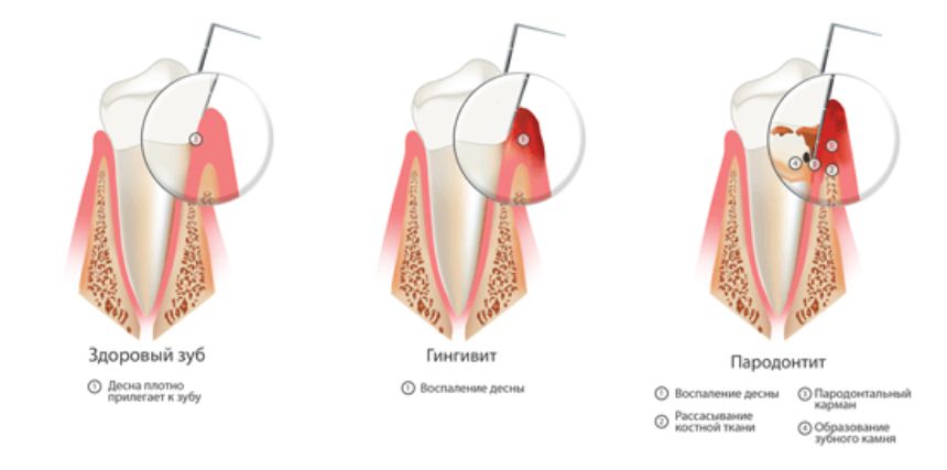 Что делать, если десна отошла от зуба. Обязательно ли делать операцию