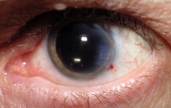 Вторичная катаракта после замены хрусталика