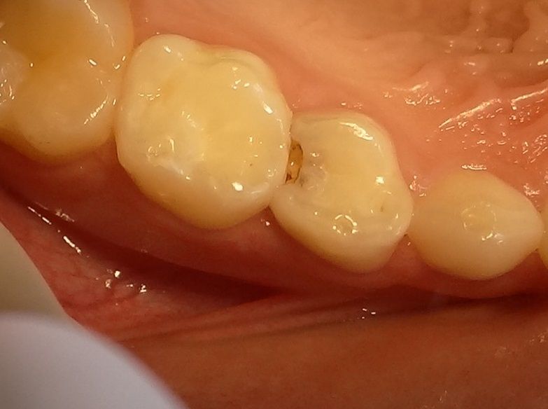 Лечение кариеса между зубами. Спасаем красоту передних зубов