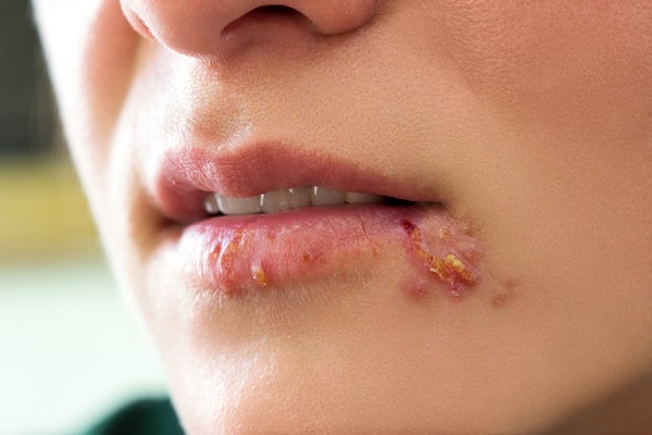 Как долго бывает заразен герпес на губах