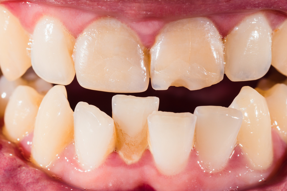 Можно ли поставить виниры на кривые зубы, для их выравнивания? Что эти накладки могут исправить