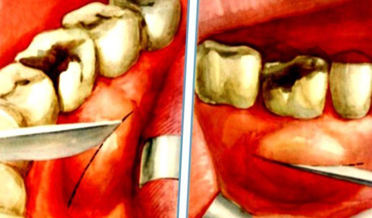 Почему после удаления зуба из десны торчит кость и надкостница