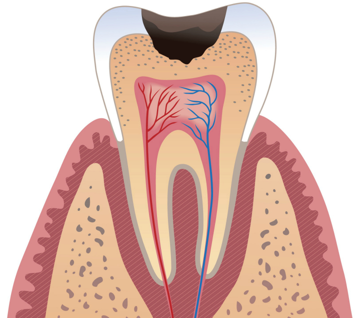 Причины и симптомы кариеса зубов узнаем, как предотвратить болезнь или избавиться от неё
