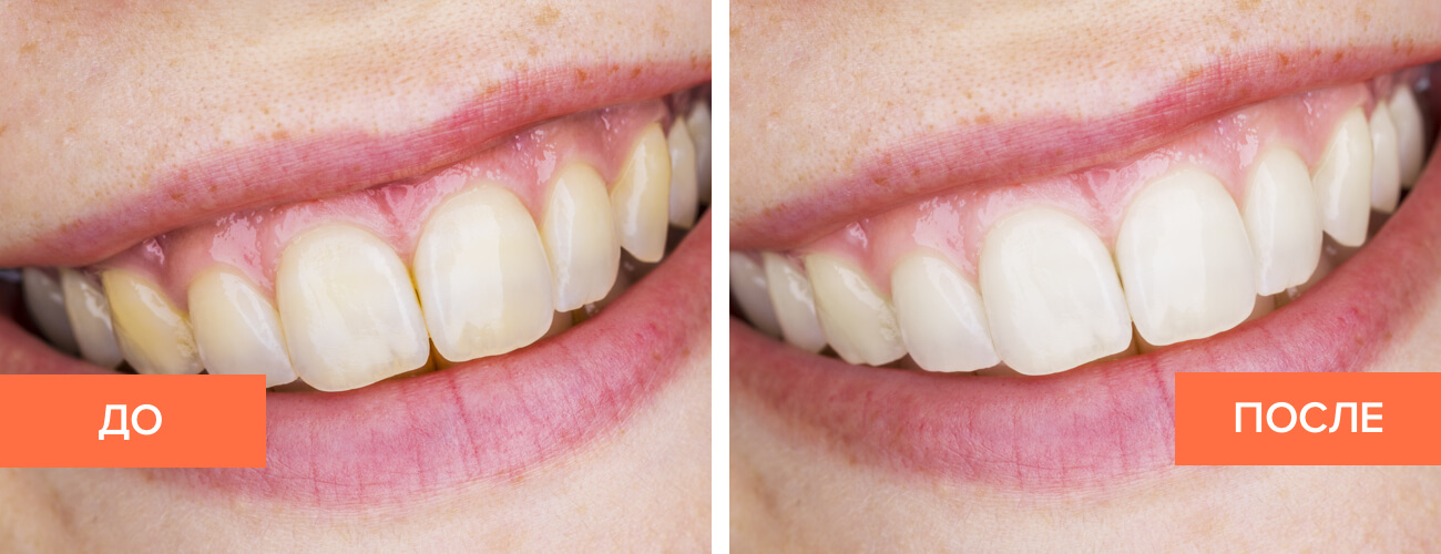 Удаление зубных камней и отбеливание зубов белые зубные щетки