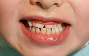 Что делать, если молочные зубы растут криво?
