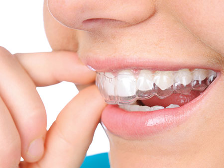 Что такое брекет-система. Что произойдет с вашими зубами после ношения брекетов
