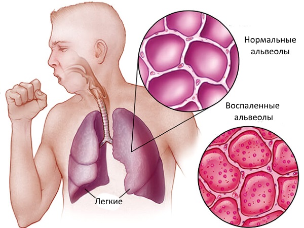 Альвеолы в норме и при пневмонии