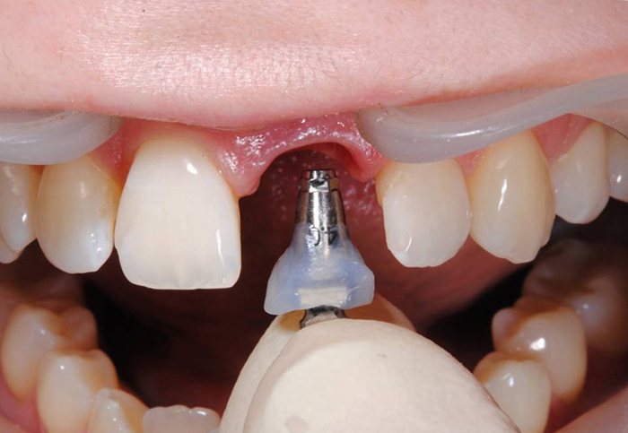 Что такое одномоментная имплантация зубов. Быстрый метод протезирования сразу после удаления зуба