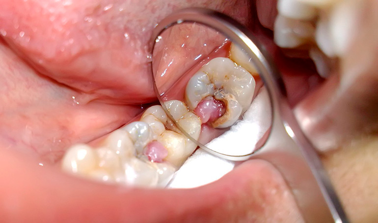 Воспаление нерва пульпит зуба, что это такое