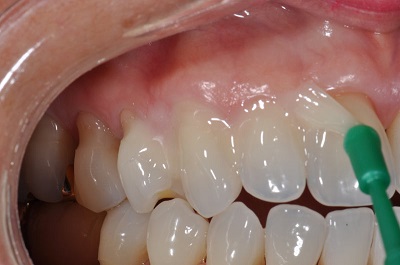 Детская стоматология серебрение молочных зубов у детей