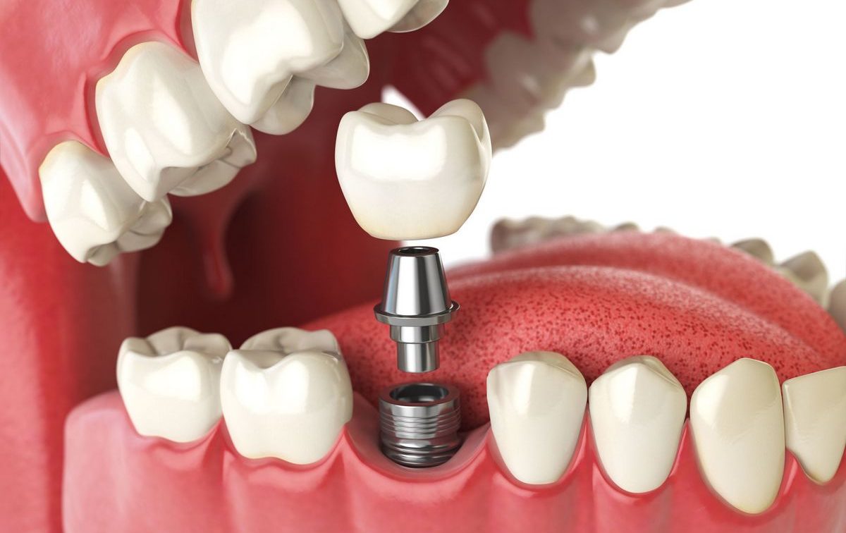 Как ставят зубные импланты. Этапы имплантации и возможные осложнения