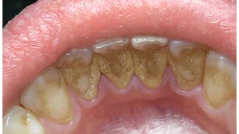Что такое зубной камень. Три способа удаления твердых отложений на зубах