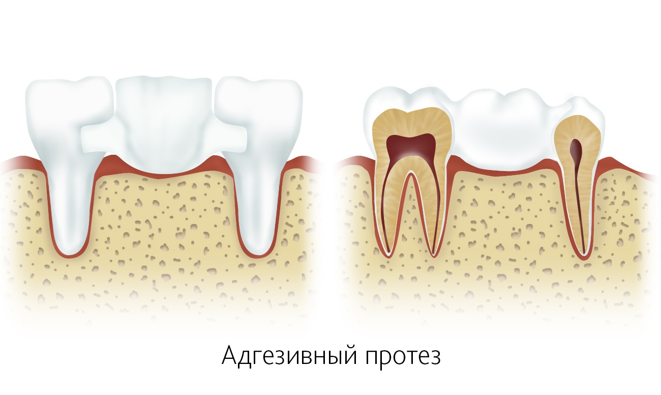 Методы протезирования зубов без обточки. Мостовидные протезы и не только