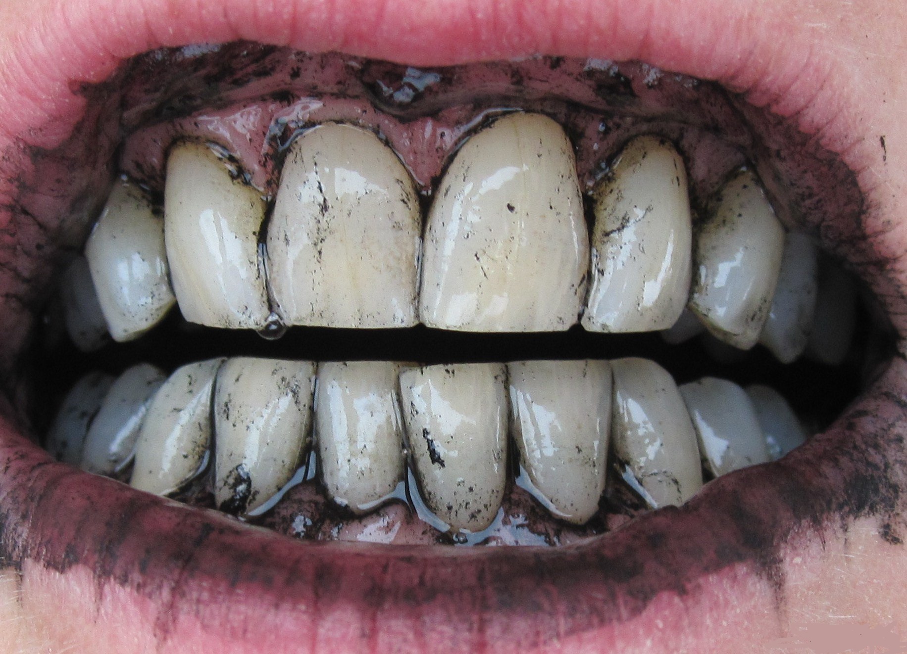 фото черных зубов у детей