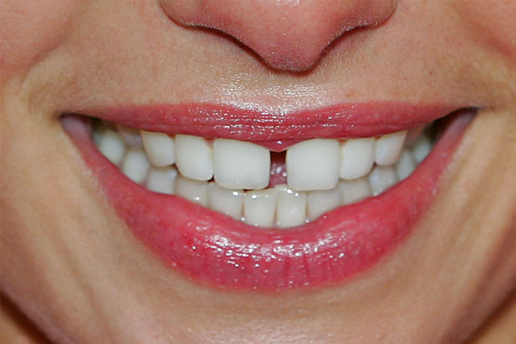 От чего появляется щель между передними зубами, и как её убрать