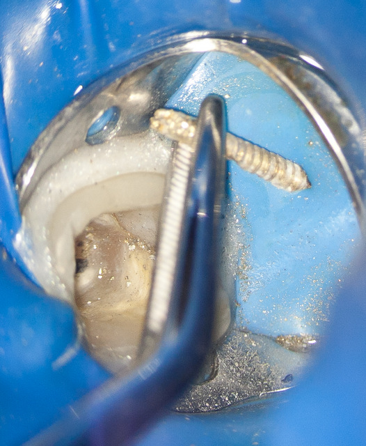 Причины и процедура удаление импланта зуба со штифтом. Опасные последствия