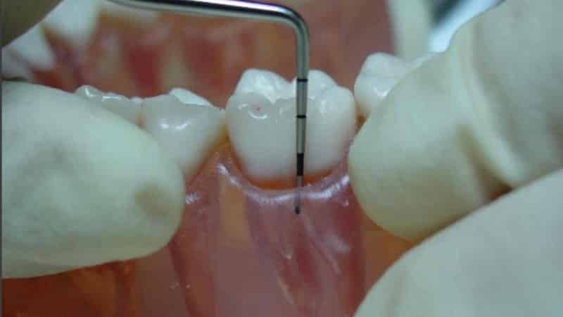 Что такое кюретаж пародонтального кармана в стоматологии