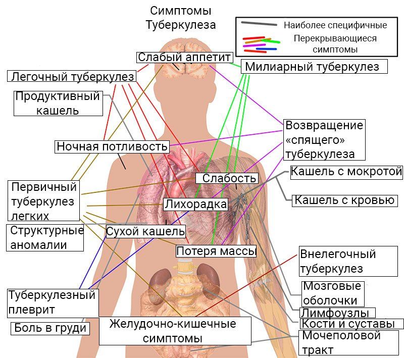 Признаки туберкулеза