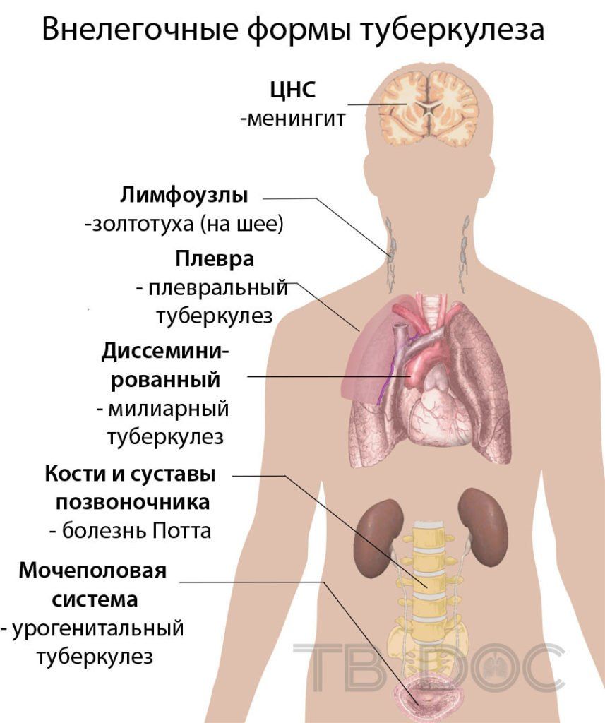 Какие есть формы внелегочного туберкулеза