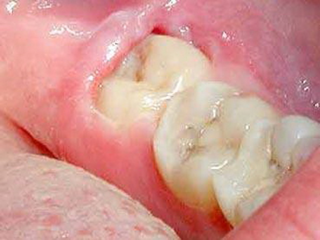 Инструкция по применению хлоргексидина для полоскания рта при воспалении дёсен и после удаления зуба