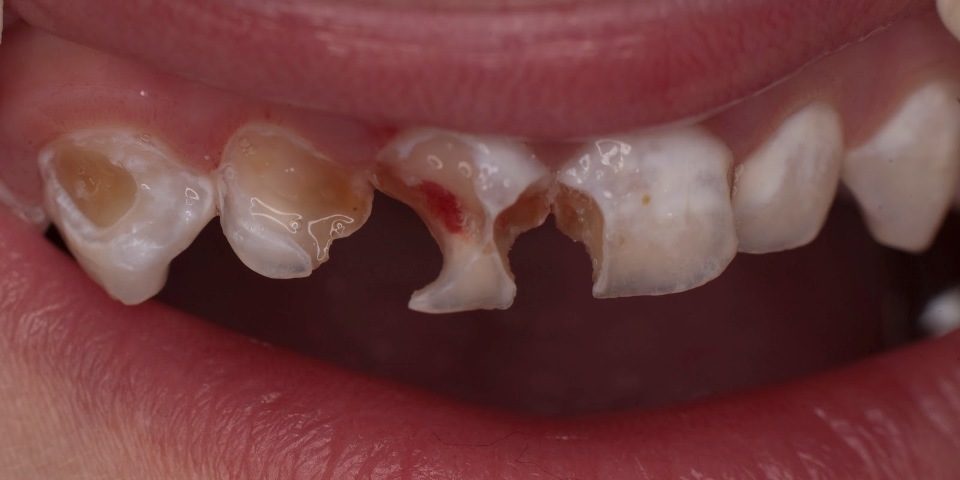 Опасное явление гнилые зубы у детей