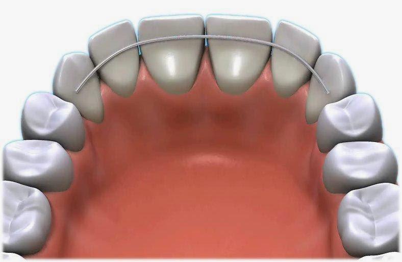 Лечение воспаления десневого кармана в стоматологии и в домашних условиях