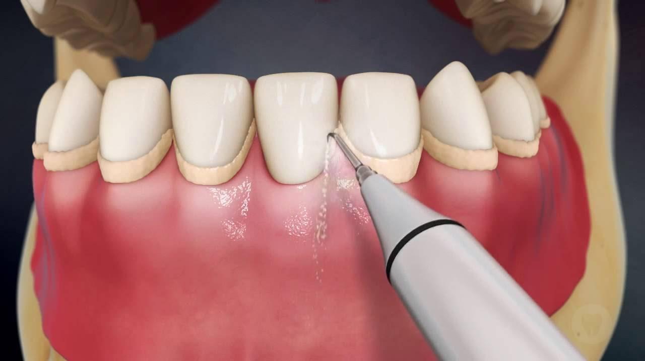 Что такое ультразвуковая чистка зубов. Эффективное отбеливание и удаление зубного камня