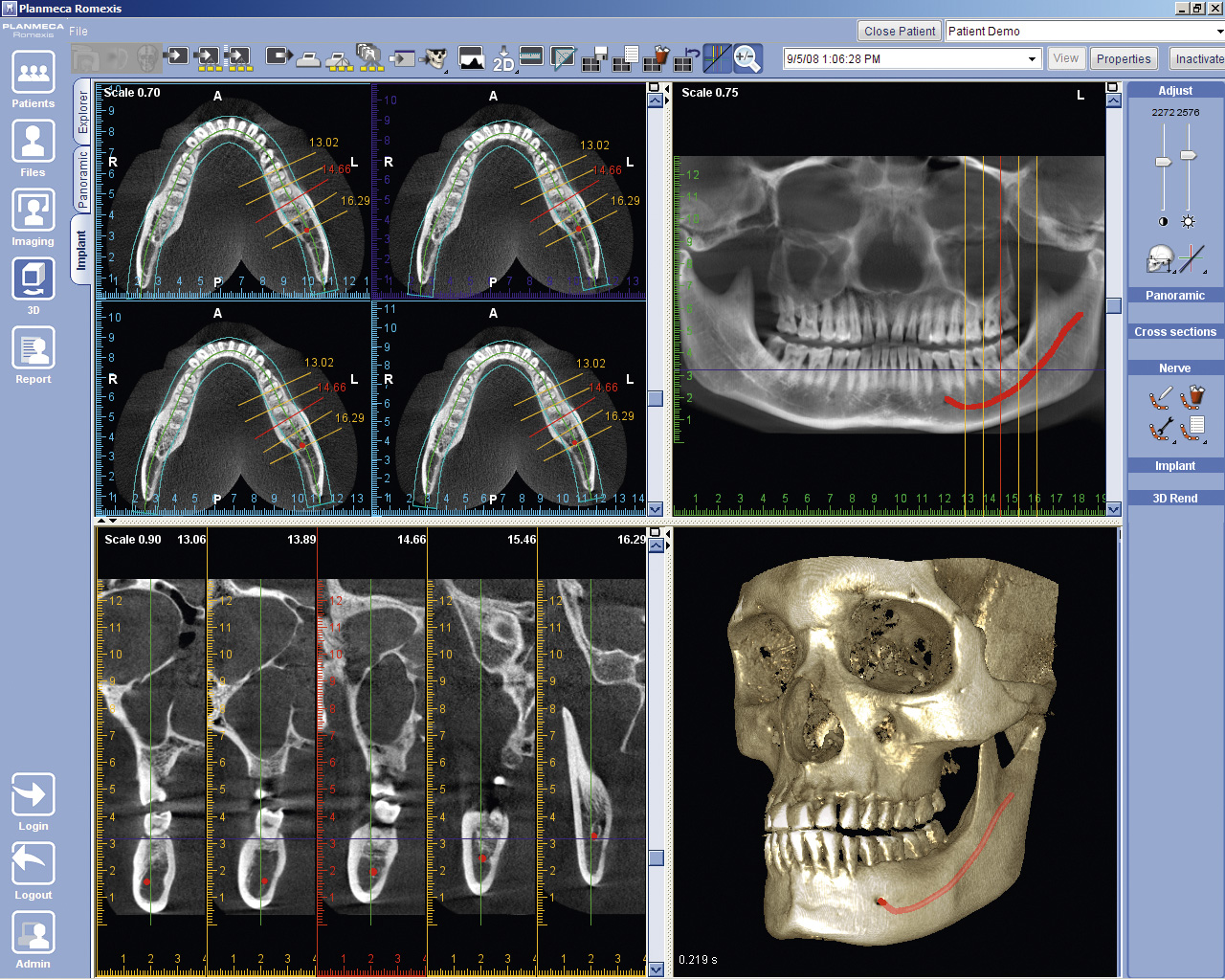Компьютерная томография челюстей VATECH